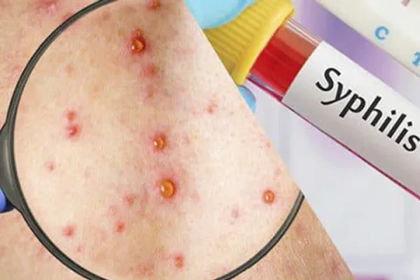 Sifilis1